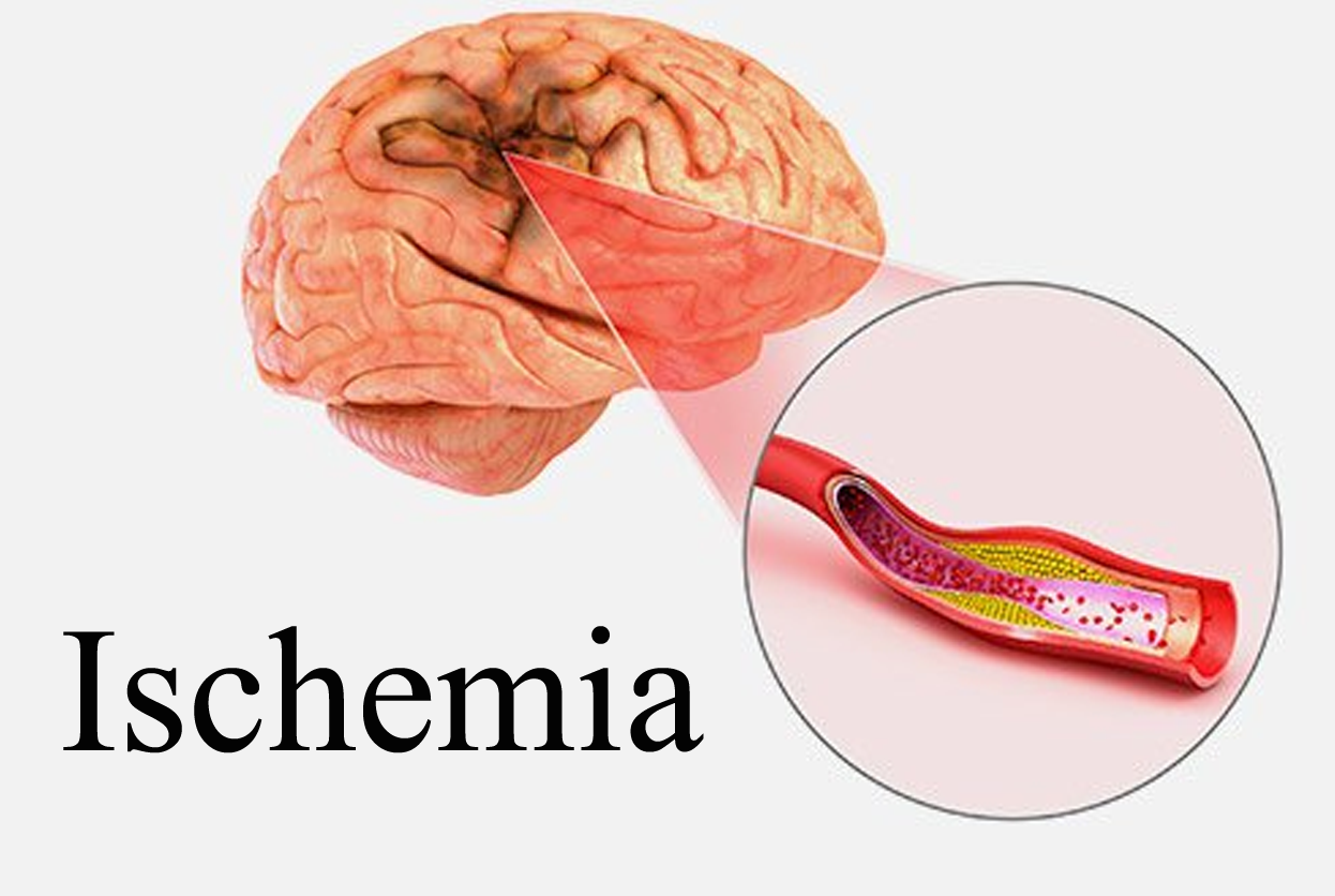 ISCHEMIA