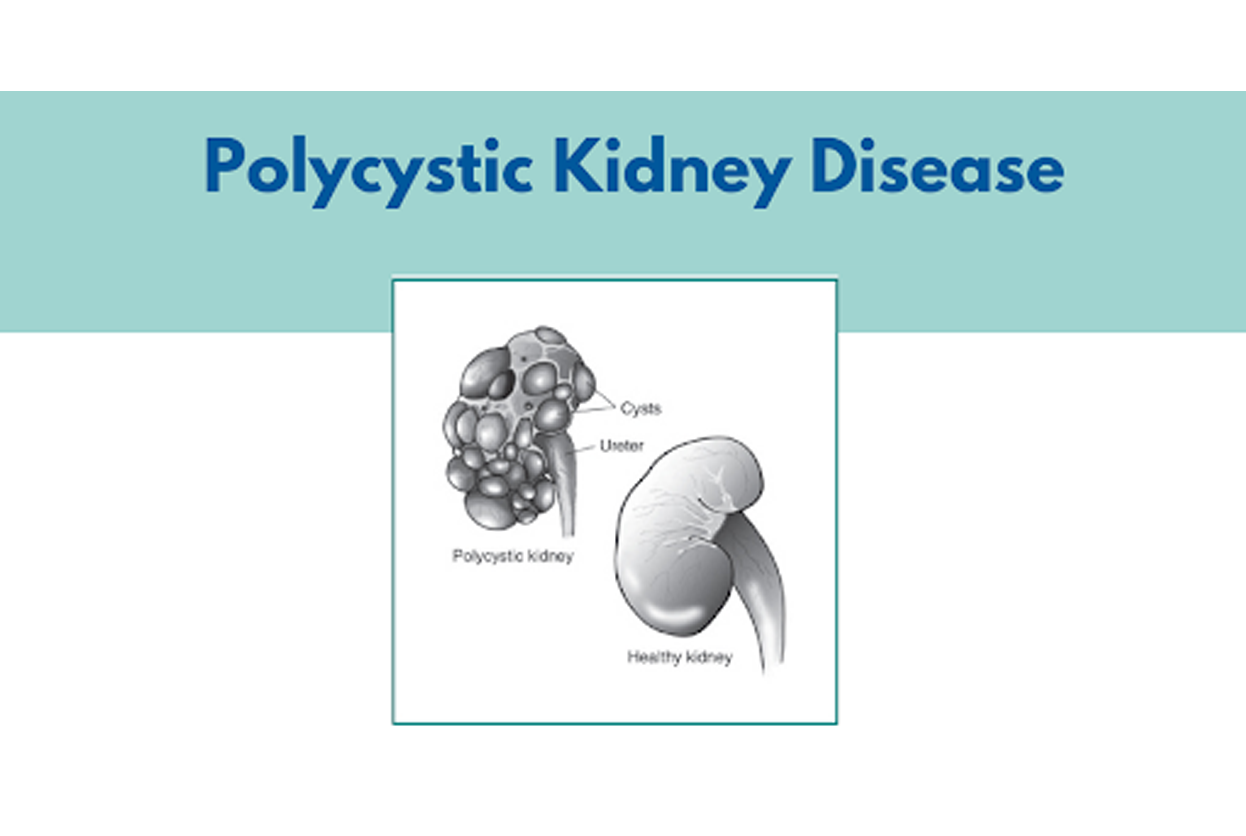 Kidney Cysts