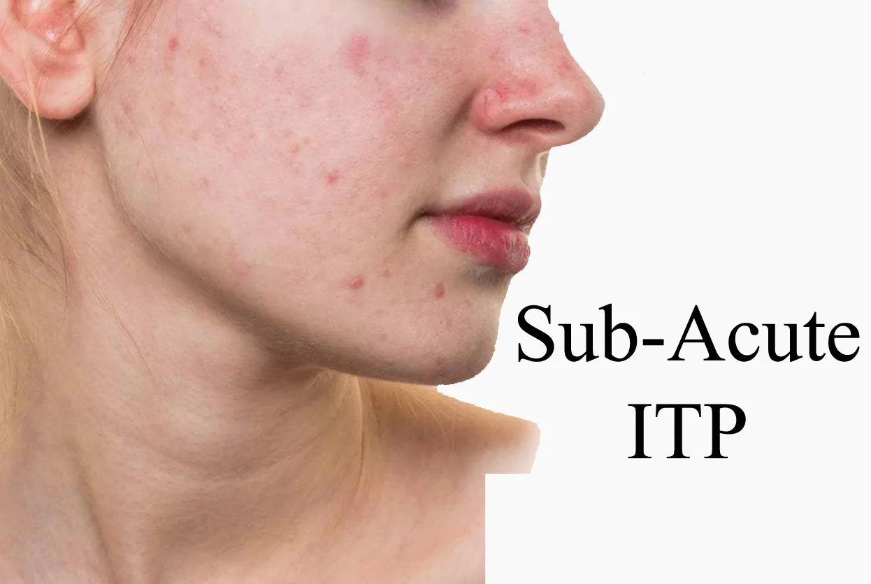 ITP SUB-ACUTE ITP