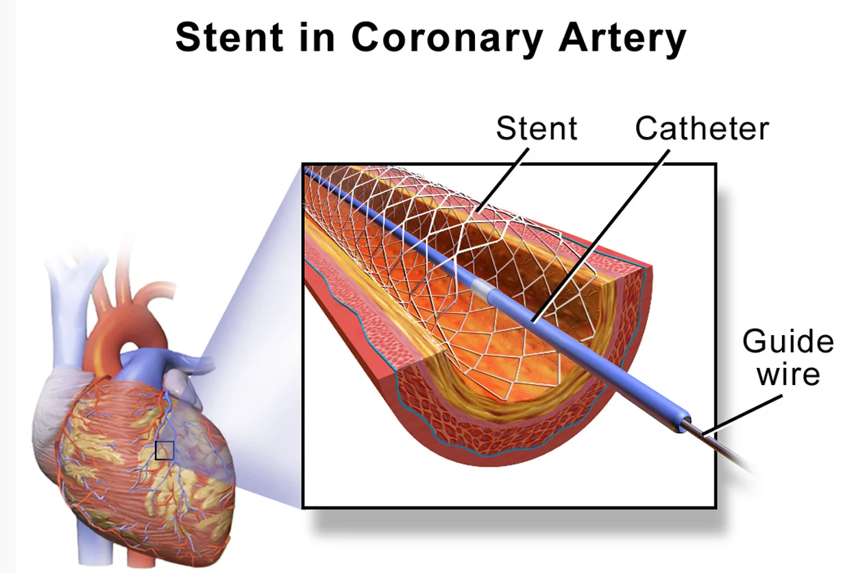 STENTING (MEDICINAL)