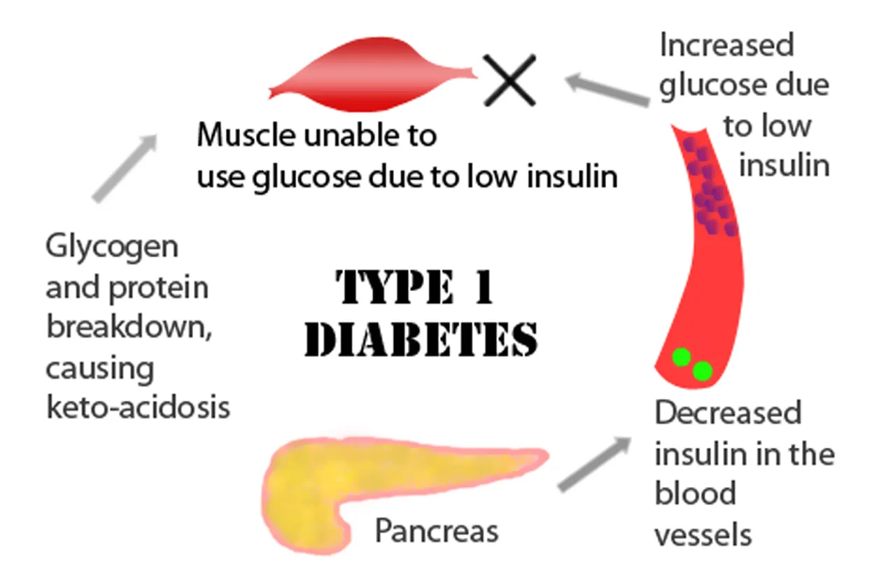 DIABETES TYPE - 1