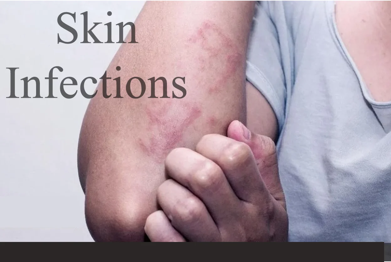 SKIN INFECTIONS