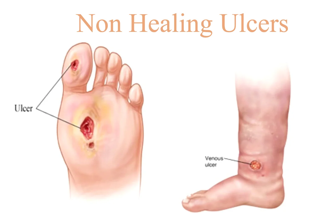 NON HEALING ULCERS