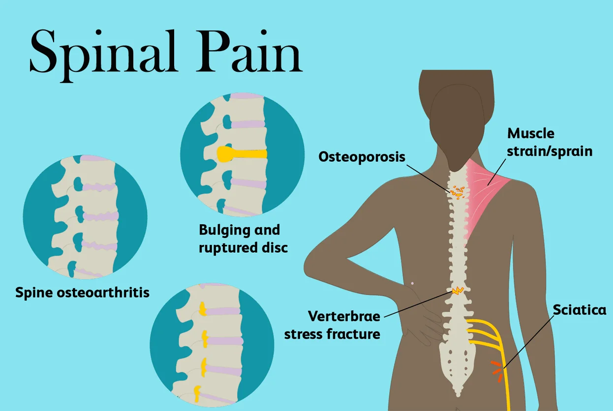 Spinal Pain