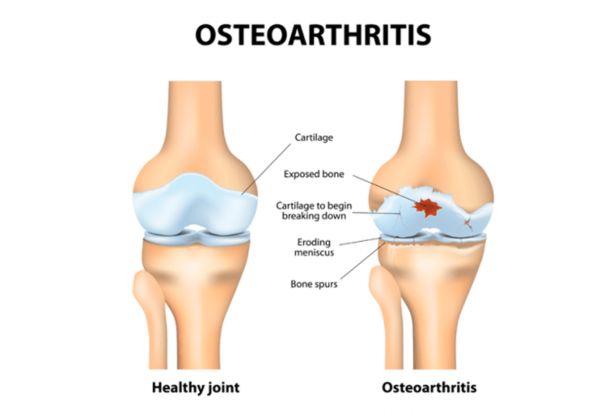 Osteoarthritis