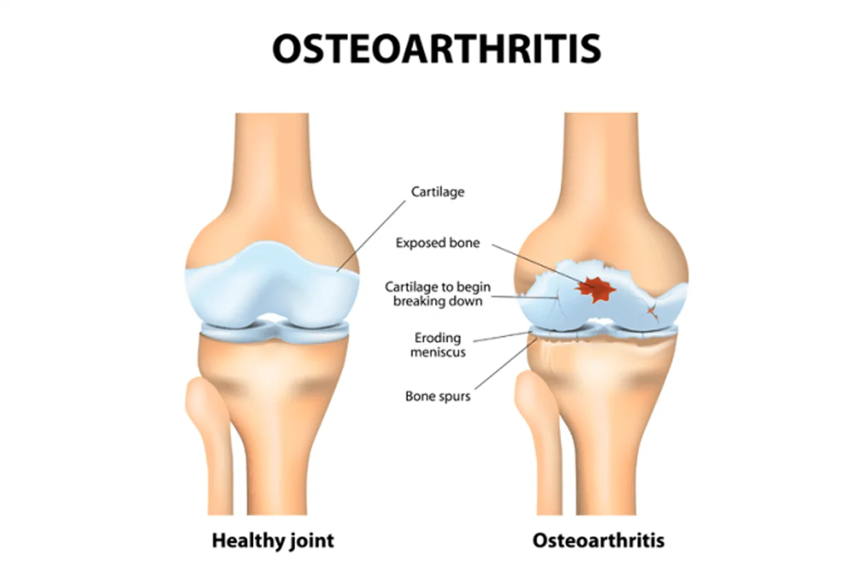 Osteoarthritis