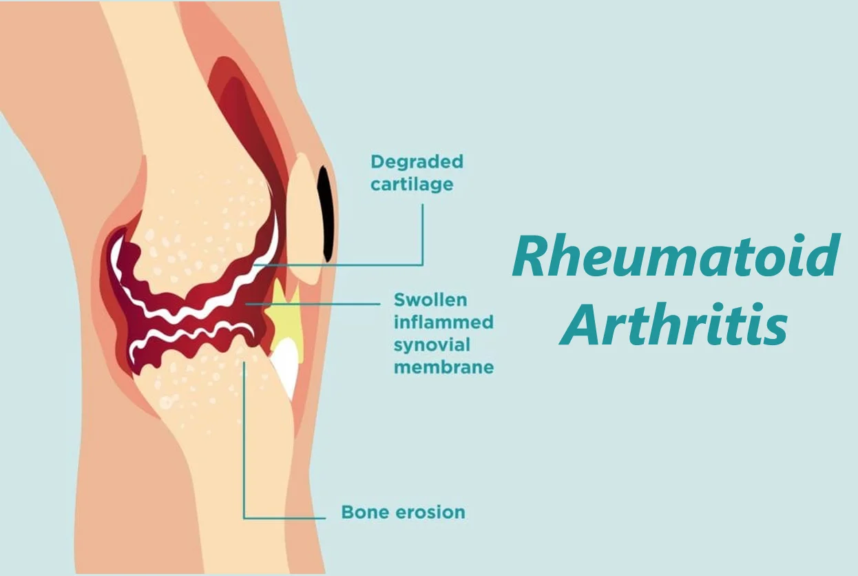 Rheumatoid Arthritis