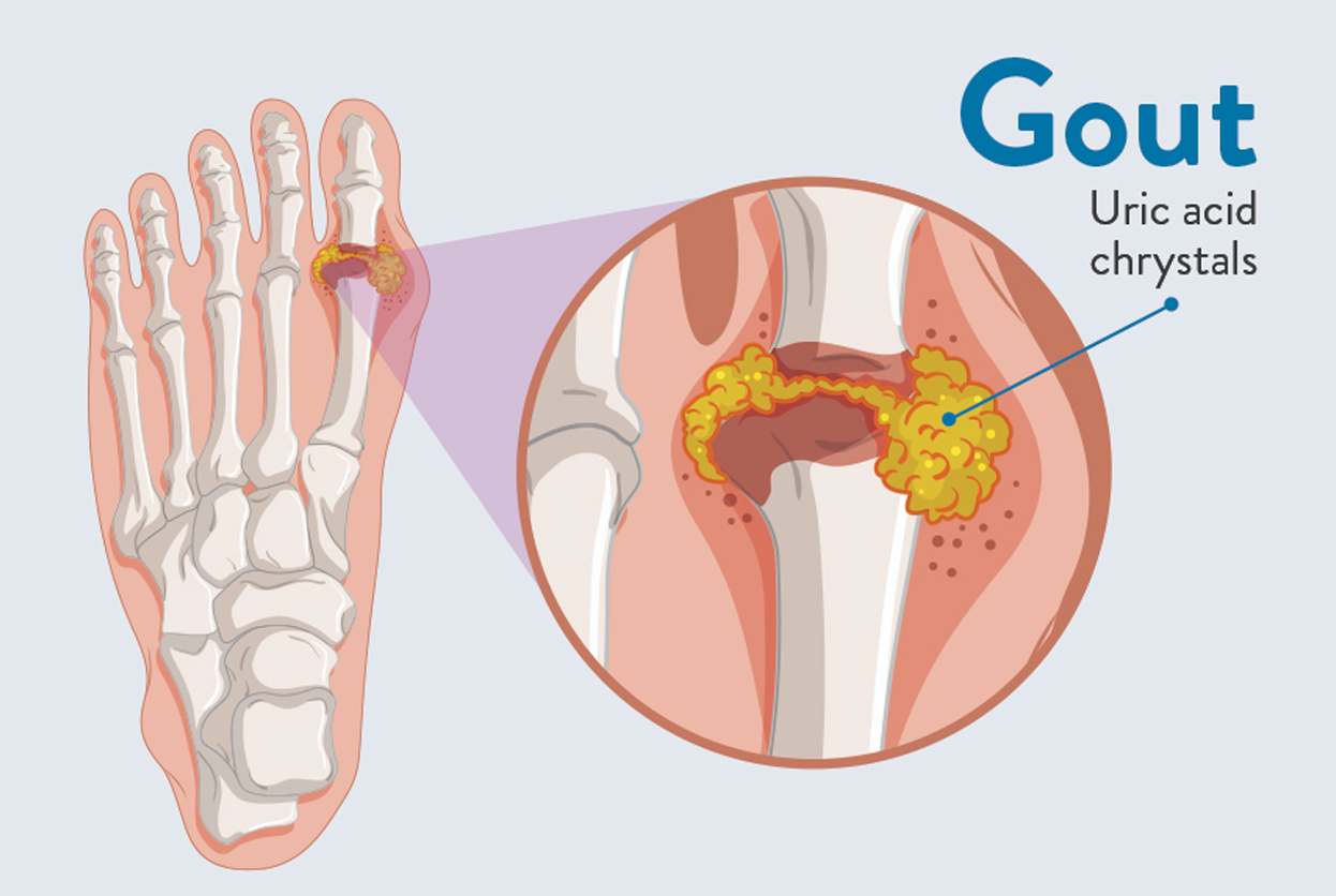 GOUT