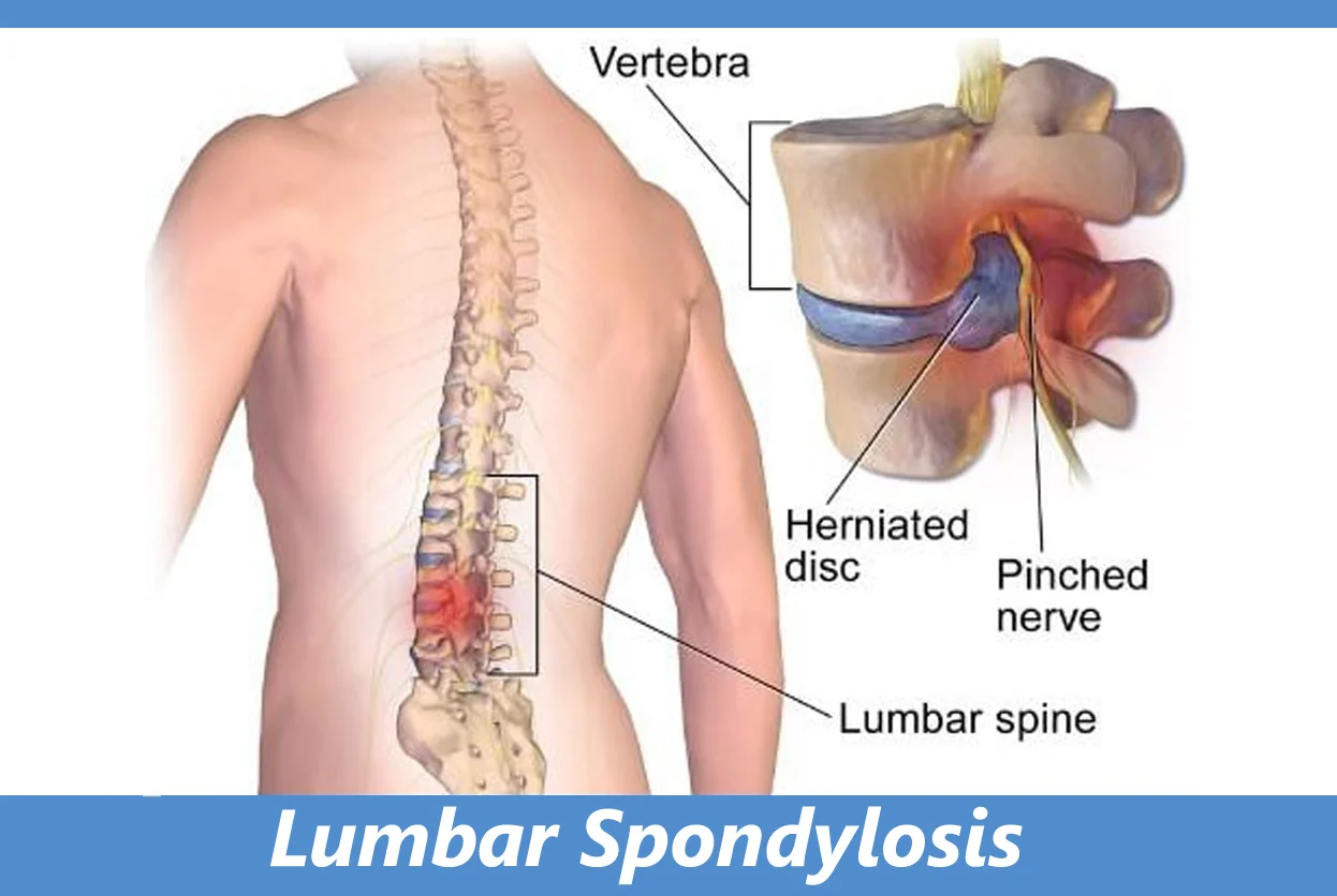 LUMBAR SPONDYLOSIS