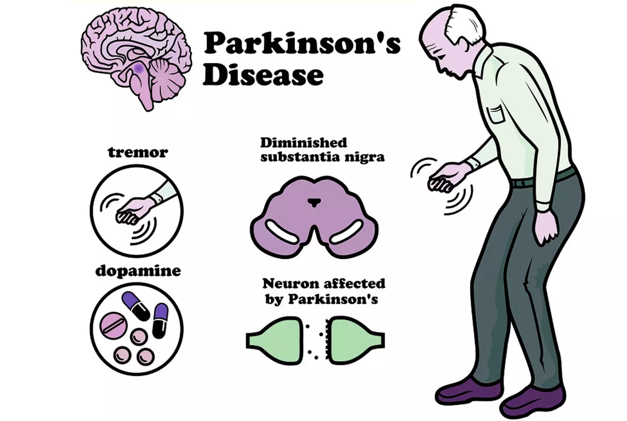 PARKINSON'S DISEASE